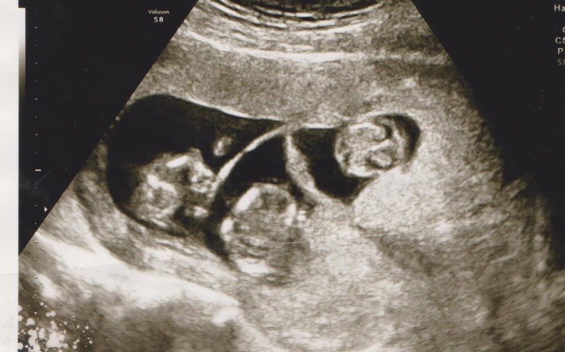 お腹の中に３人の赤ちゃんが 三つ子ちゃんのエコー写真 ママスタ