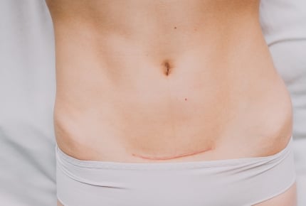 帝王切開の傷痕がミミズ腫れに……保険治療でケアできるって知っていましたか?
