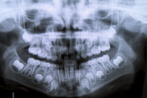 Panoramic dental x-ray of child of eight years with the problem of not loosing his baby teeth - persistent baby teeth