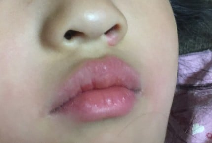 【体験レポート】いつも鼻血が出て心配! 小児科オンラインで相談してみました